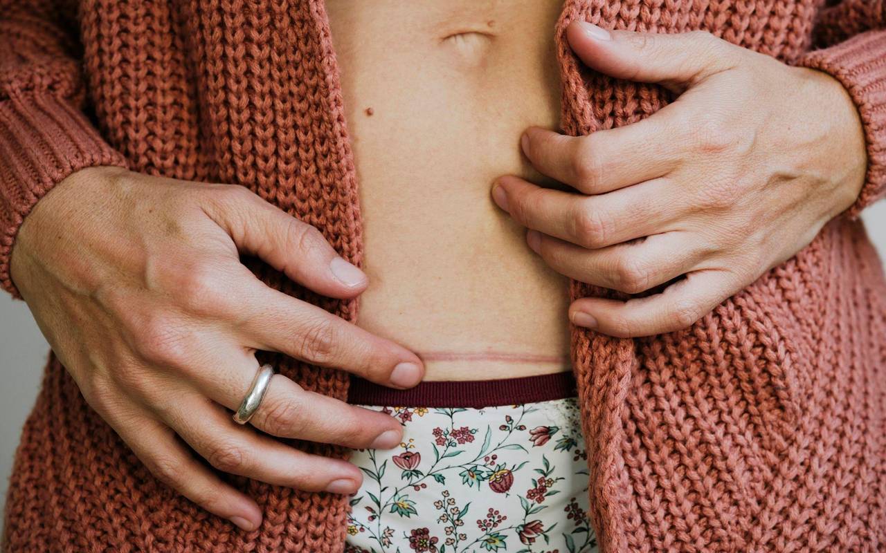 Eine Frau berührt ihre Kaiserschnittnarbe